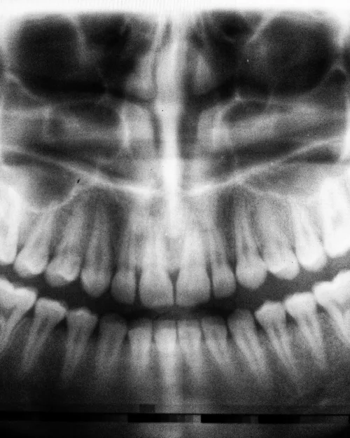 mouth xray
