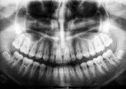 mouth xray